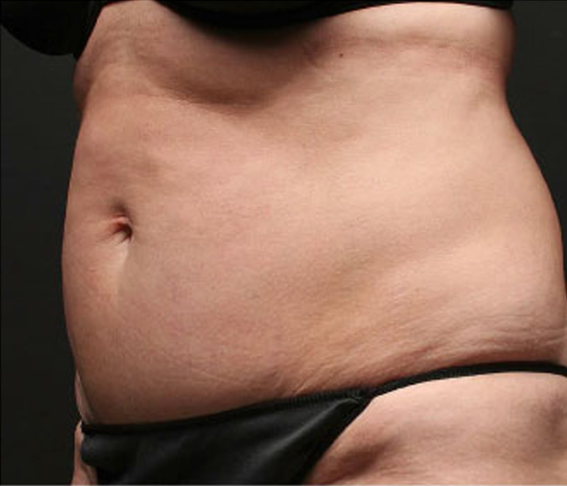 Cuerpo antes del tratamiento Thermage